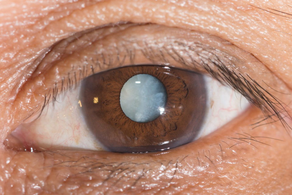 Лечение катаракты заменой хрусталика